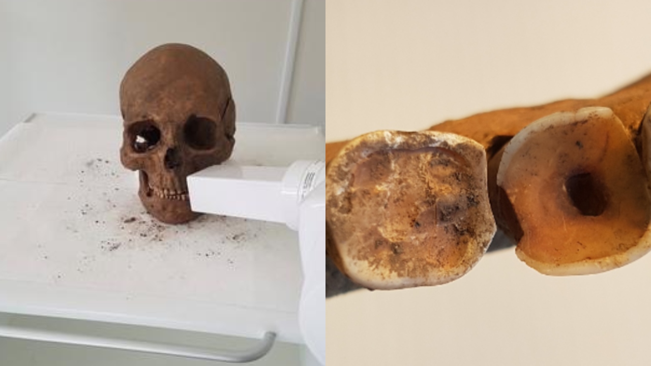 Dentes mostram que vikings cuidavam de cárie e infecções