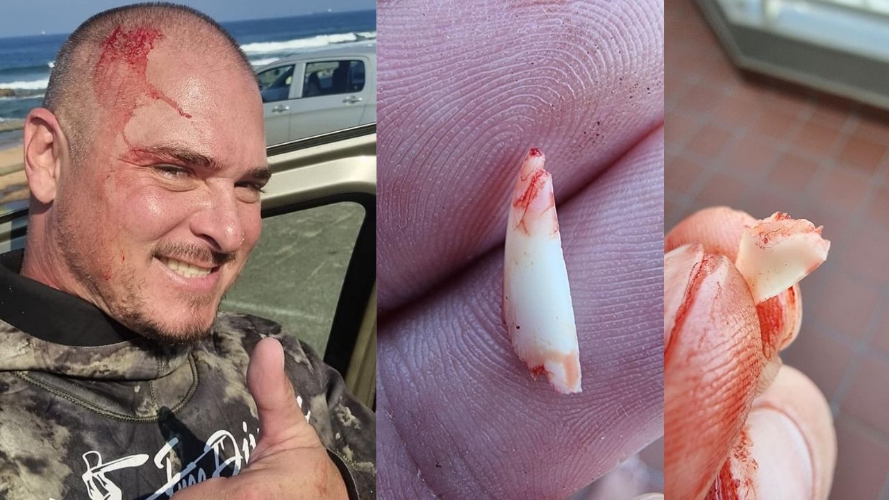 Pescador é mordido por tubarão e precisa arrancar dente da cabeça