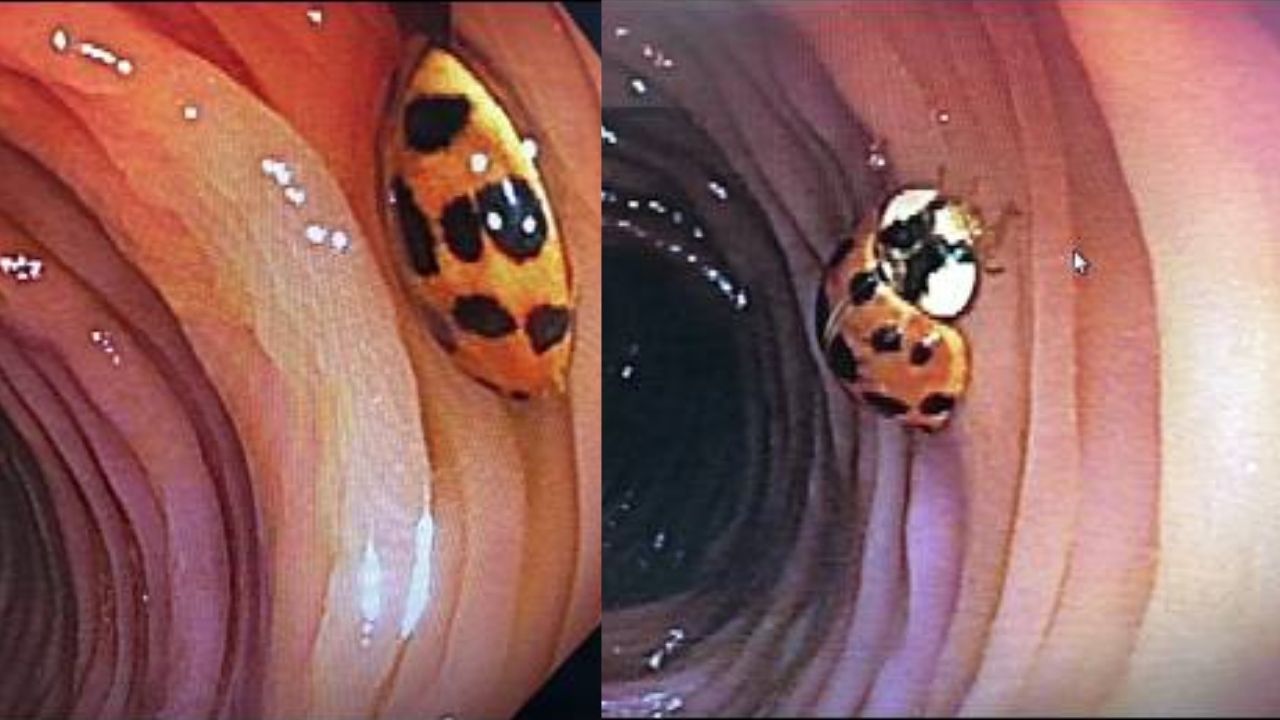 Homem faz exame de rotina e descobre joaninha vivendo em seu intestino