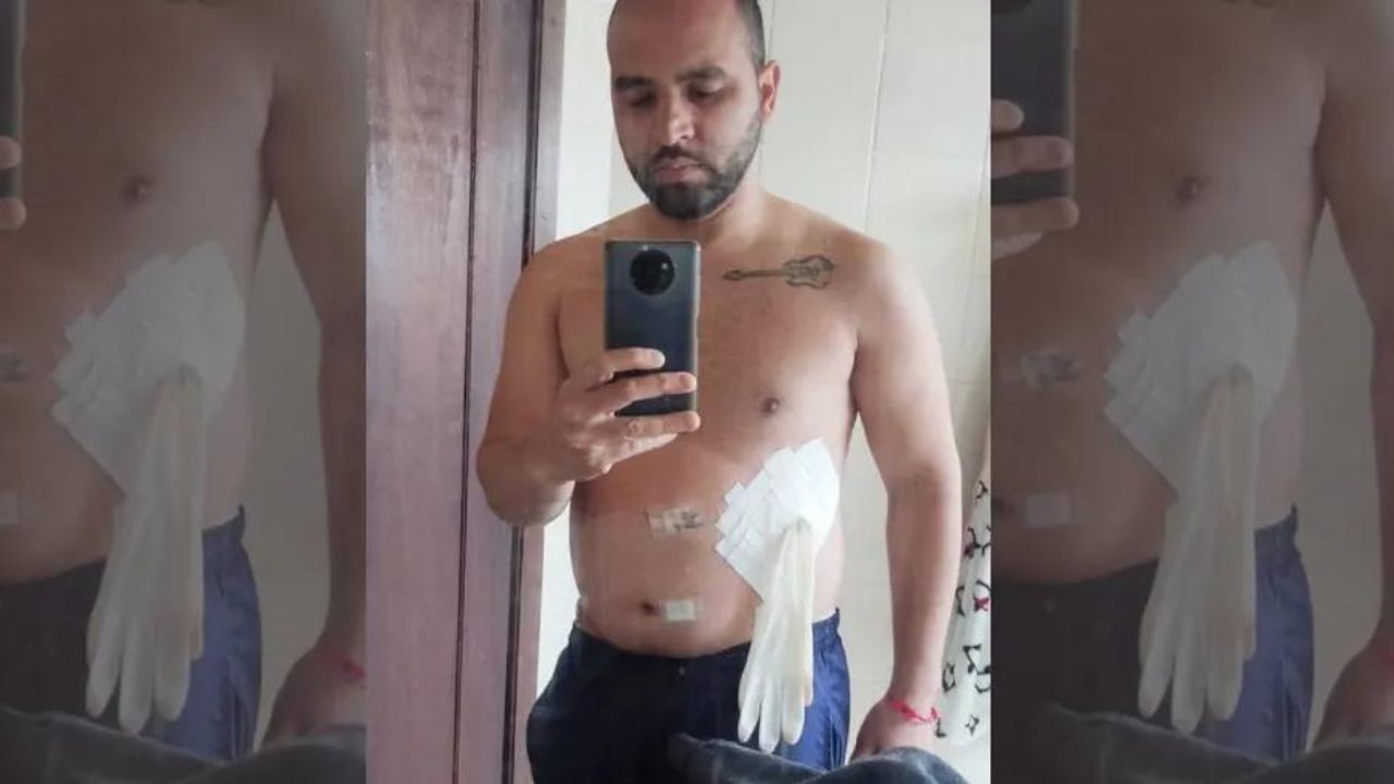 Médico improvisa bolsa de colostomia com luva cirúrgica em paciente