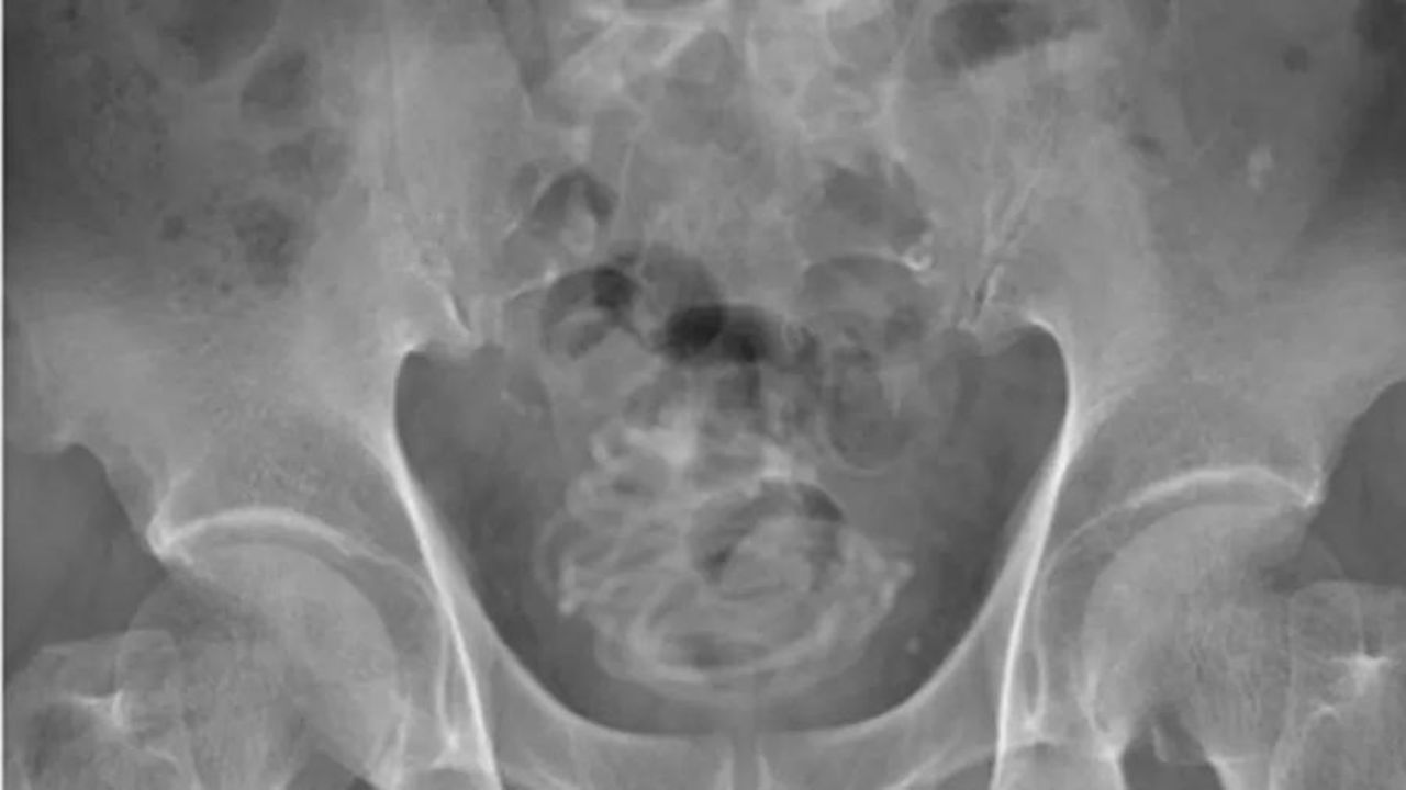 Homem de 79 anos passa por cirurgia para remover corda de 2 metros que introduziu na uretra