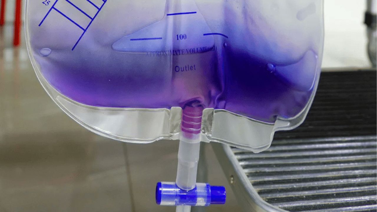 Síndrome da bolsa de urina roxa é estudada por médicos de Oxford