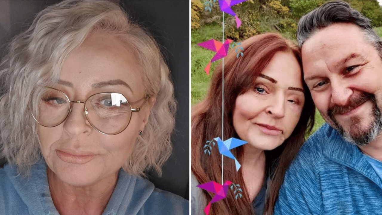 Mulher perde metade do rosto e quase morre depois de contrair bactéria