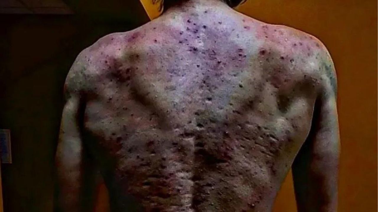Jovem desenvolve quadro grave de acne ao fazer uso de anabolizantes