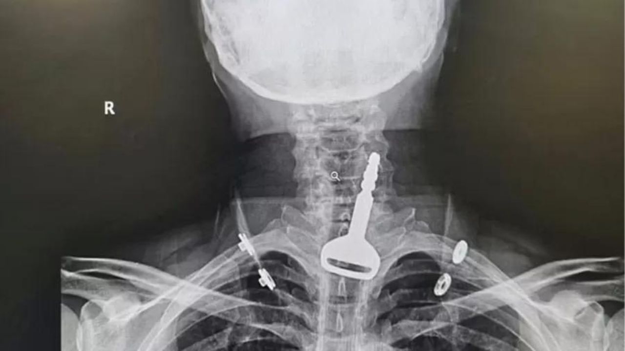 Homem faz cirurgia de emergência após ficar com chave entalada na traqueia