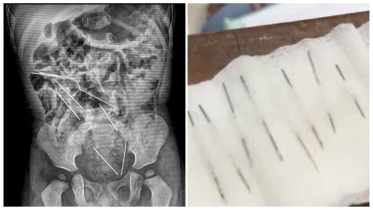 Menino de 2 anos passa por cirurgia para remoção de 8 agulhas de seu aparelho digestivo