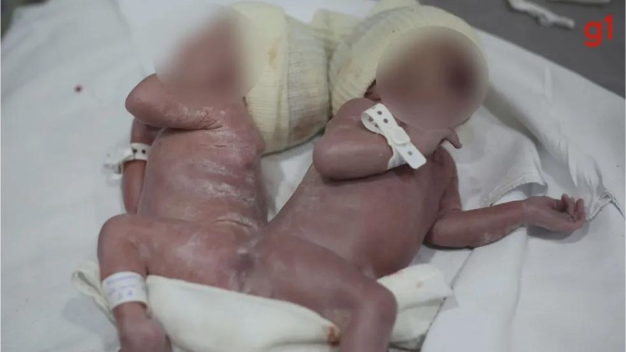 Em caso raro, gêmeos siameses nascem unidos por osso da coluna no Paraná