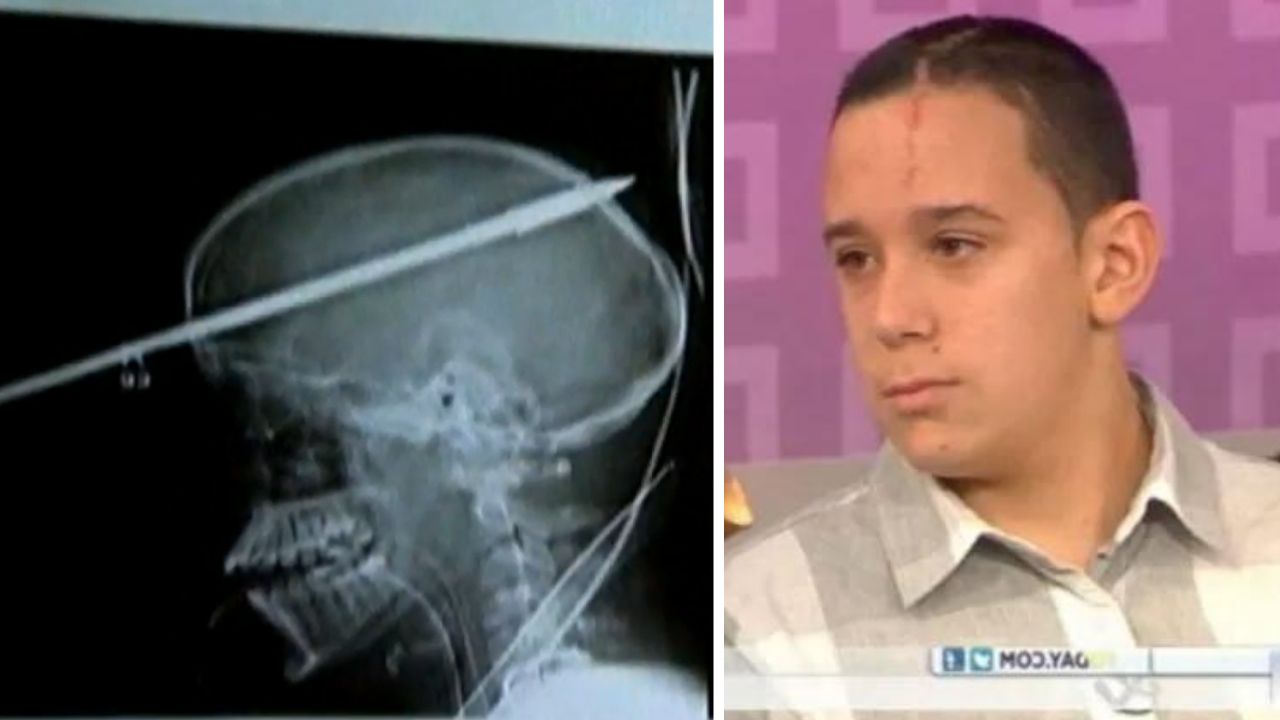 Yasser Lopez, o garoto que teve o crânio atravessado por um arpão — e sobreviveu