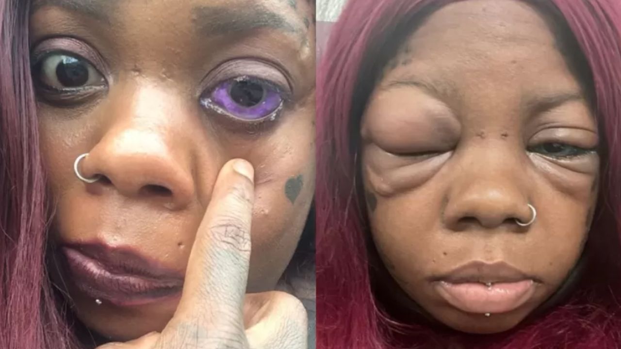 Jamaicana corre risco de perder a visão após tatuar globos oculares