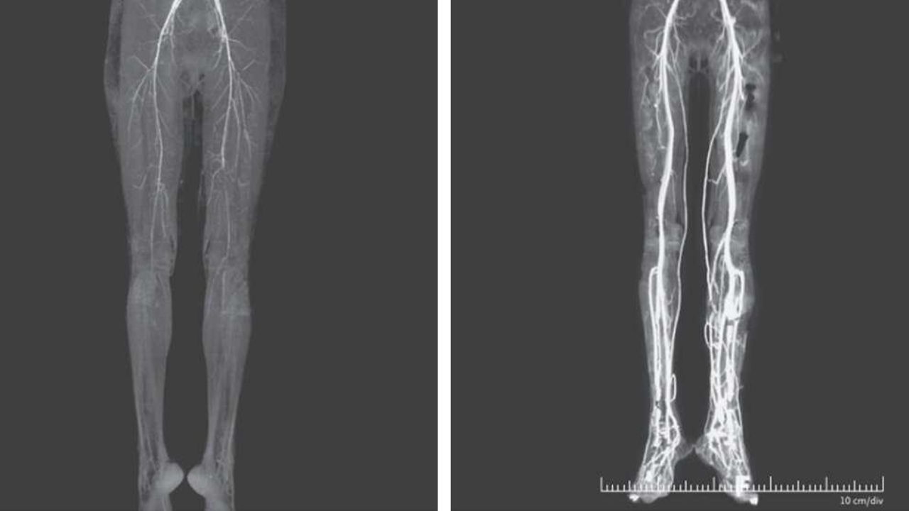 Mulher é diagnosticada com doença medieval do “fogo sagrado” na Índia