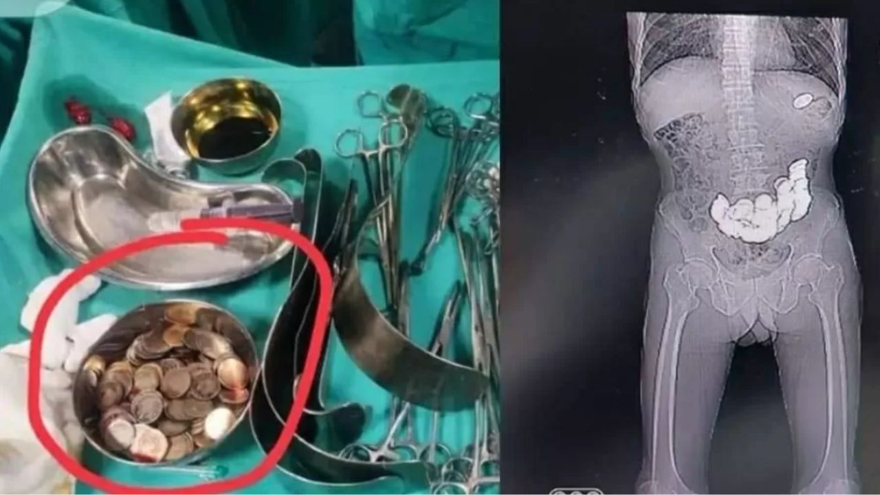 Indiano com dores abdominais passa por cirurgia e médicos encontram 187 moedas em seu corpo