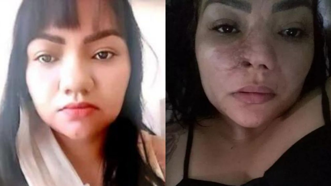 Mulher processa clínica por nariz necrosado e necessidade de dez cirurgias