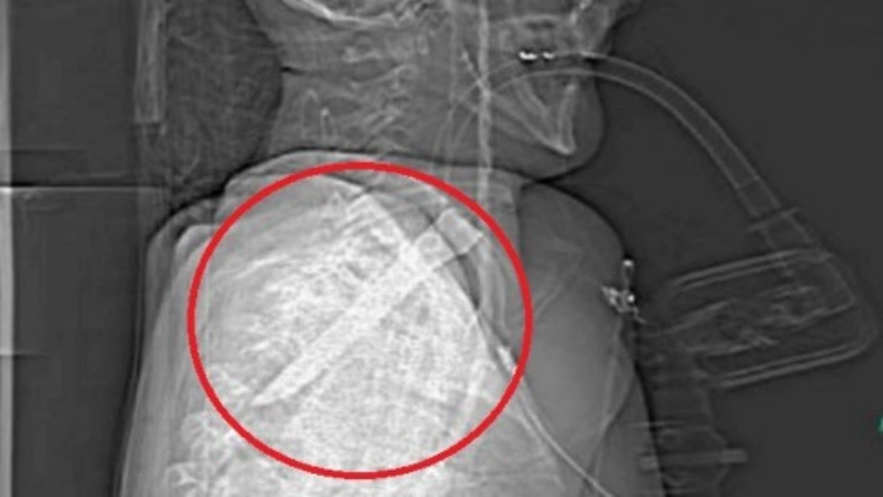 Homem sobrevive após lâmina de 14cm ficar presa em sua garganta