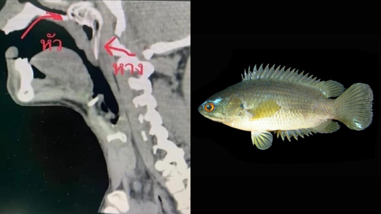 Pescador passa por cirurgia após peixe pular em sua garganta