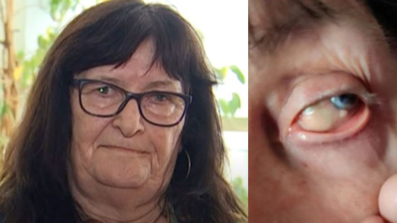Mulher processa hospitais da Espanha após passar 54 anos com pedra no olho