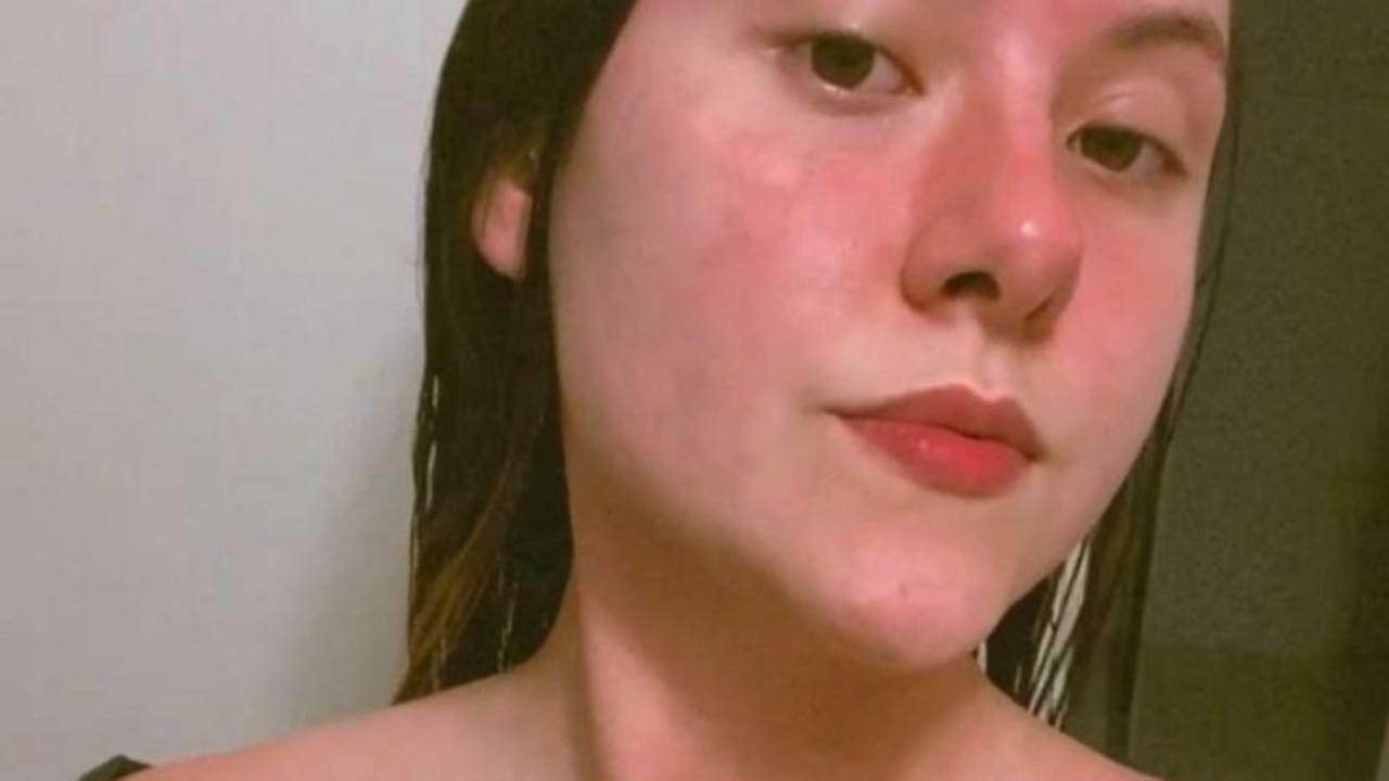 Mulher tem alergia rara com elemento do cotidiano