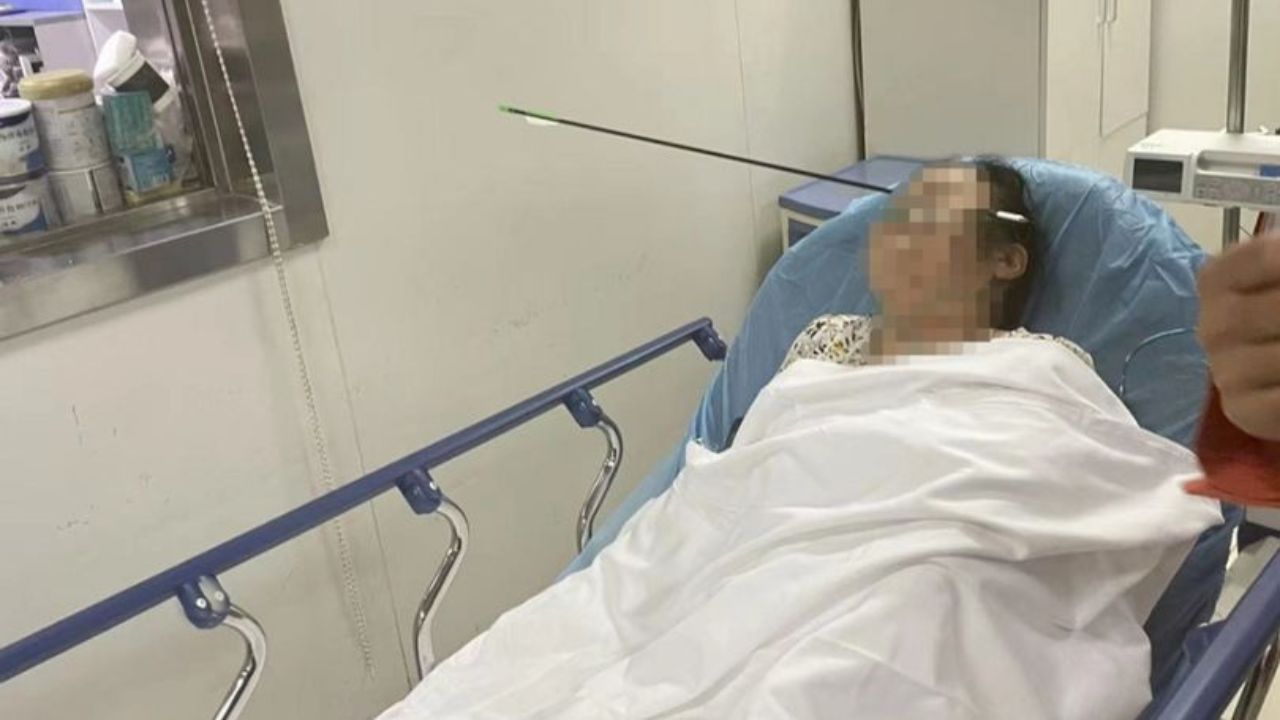 Chinesa termina com flecha alojada no rosto após tiro acidental de arqueiro