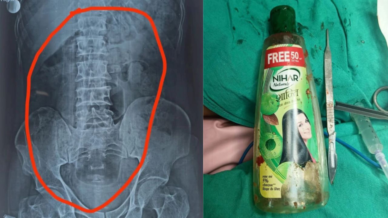 Indiano é operado às pressas após engolir garrafa de produto para cabelo