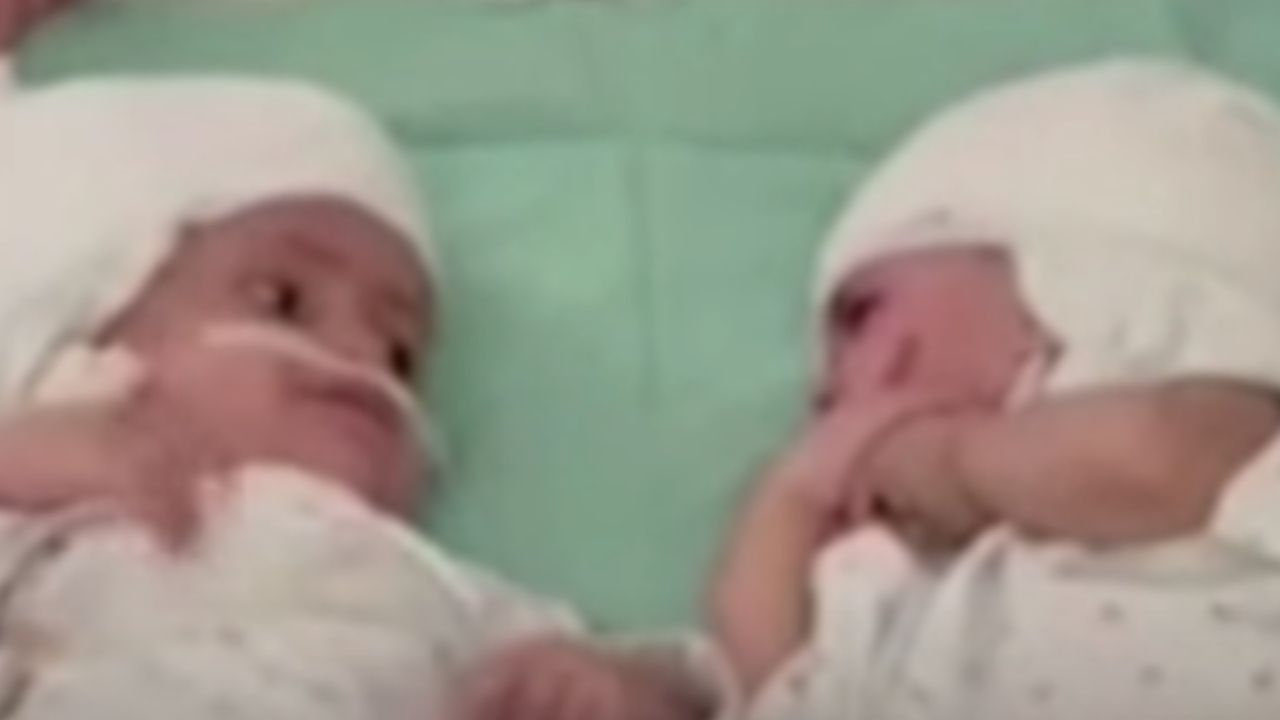 Após cirurgia, gêmeas que nasceram grudadas pela cabeça fazem contato visual pela primeira vez