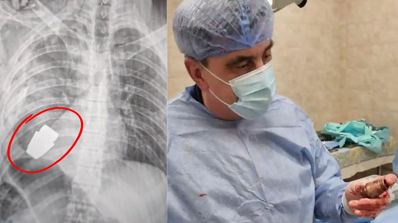 Cirurgia arriscada remove granada não detonada de peito de soldado ucraniano