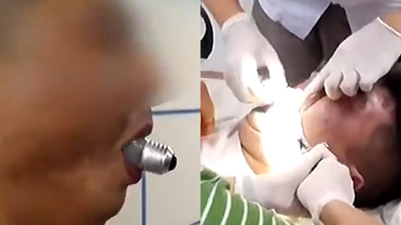 Após prender lâmpada na boca, homem vai parar em hospital na China