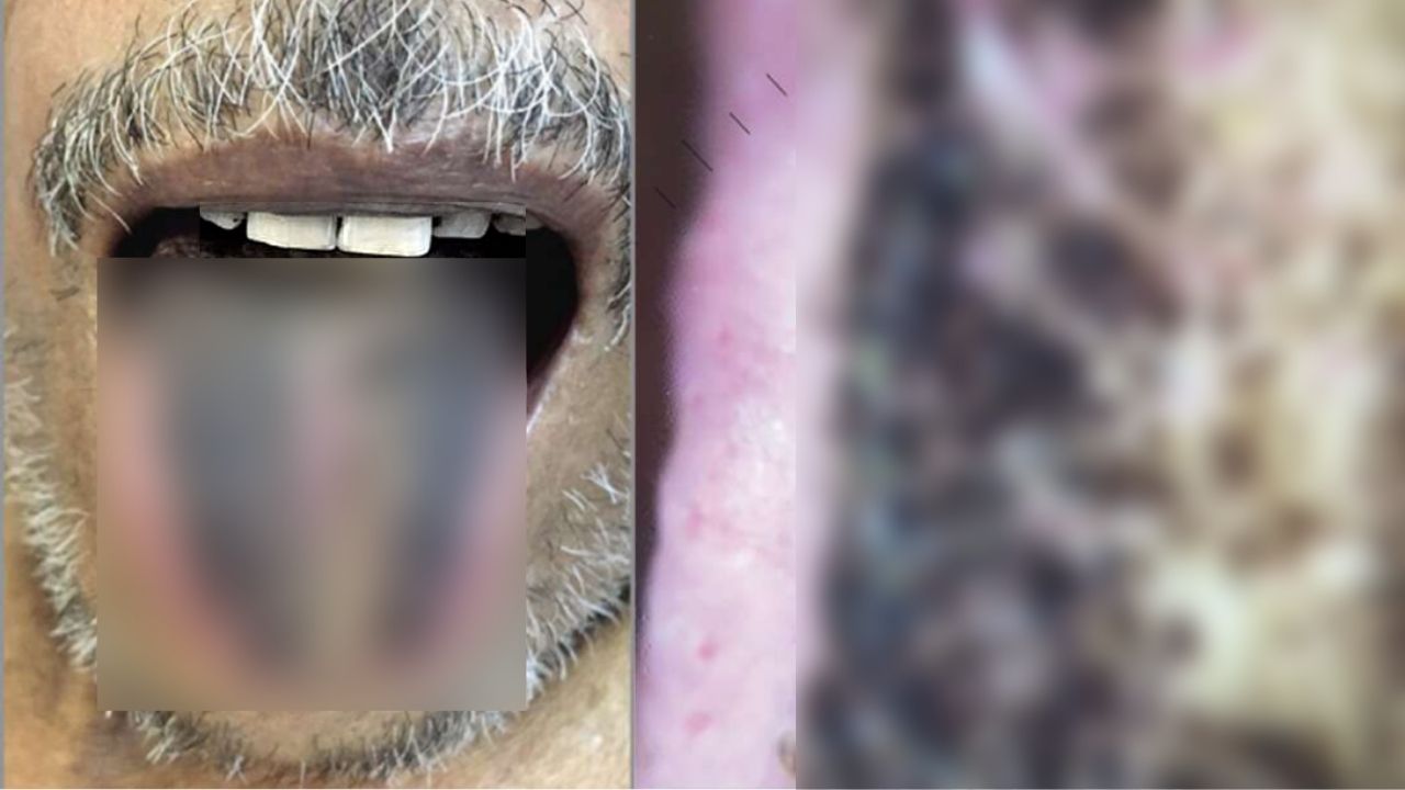 A doença que fez homem ficar com a língua preta e ‘peluda’