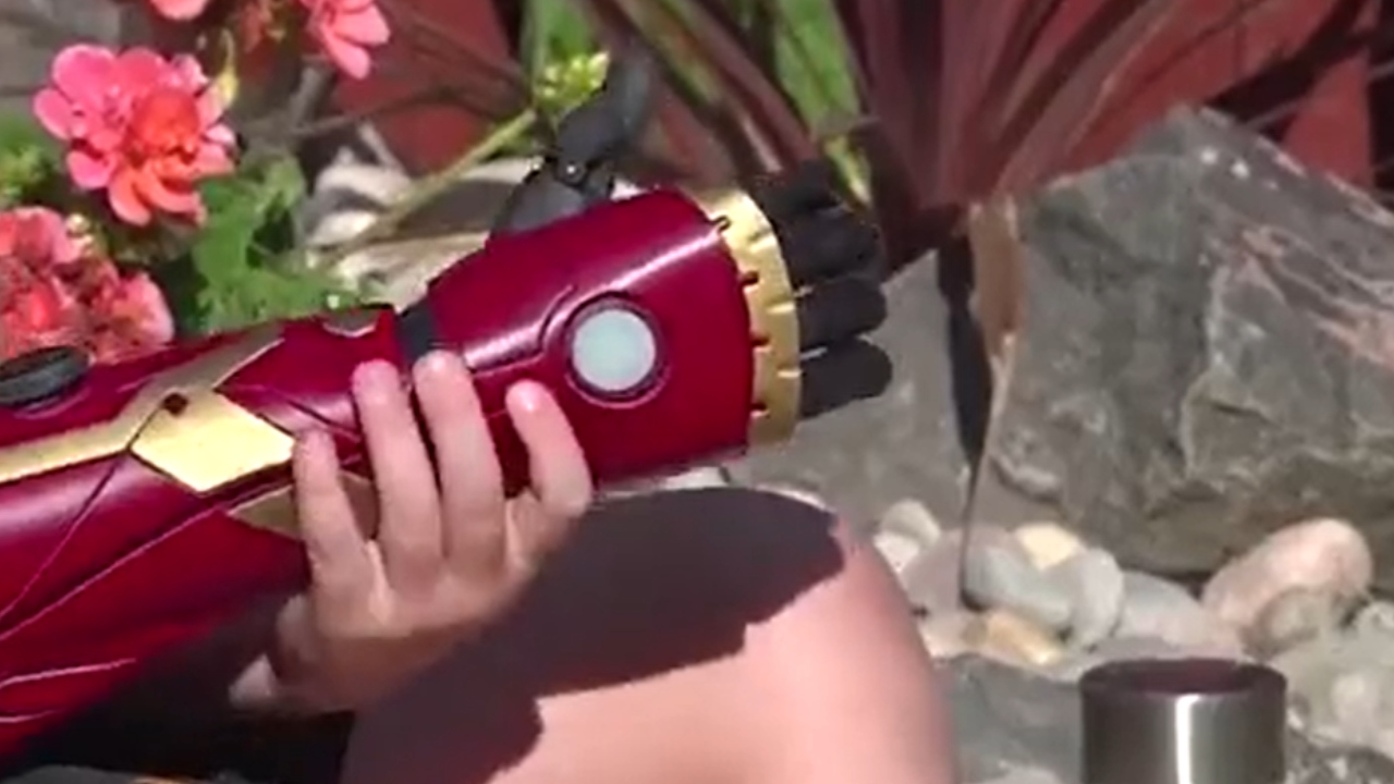 Menino com malformação é presenteado com braço biônico inspirado no Homem de Ferro