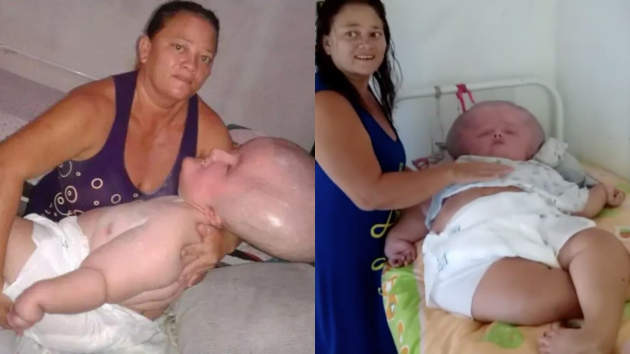 Mulher com hidrocefalia, que tinha expectativa de 3 meses de vida, completa 29 anos