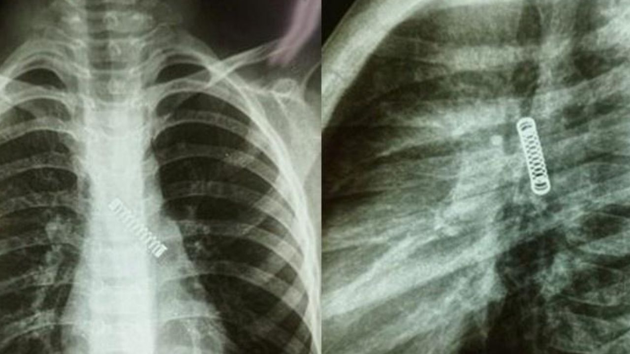 Médicos encontram mola de metal no pulmão de garoto que tossia constantemente