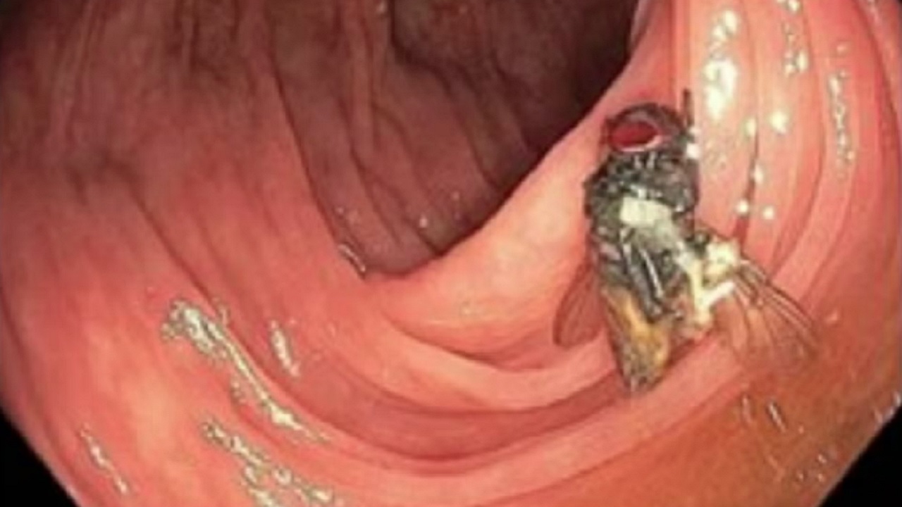 Mosca é encontrada intacta em intestino de paciente durante exame