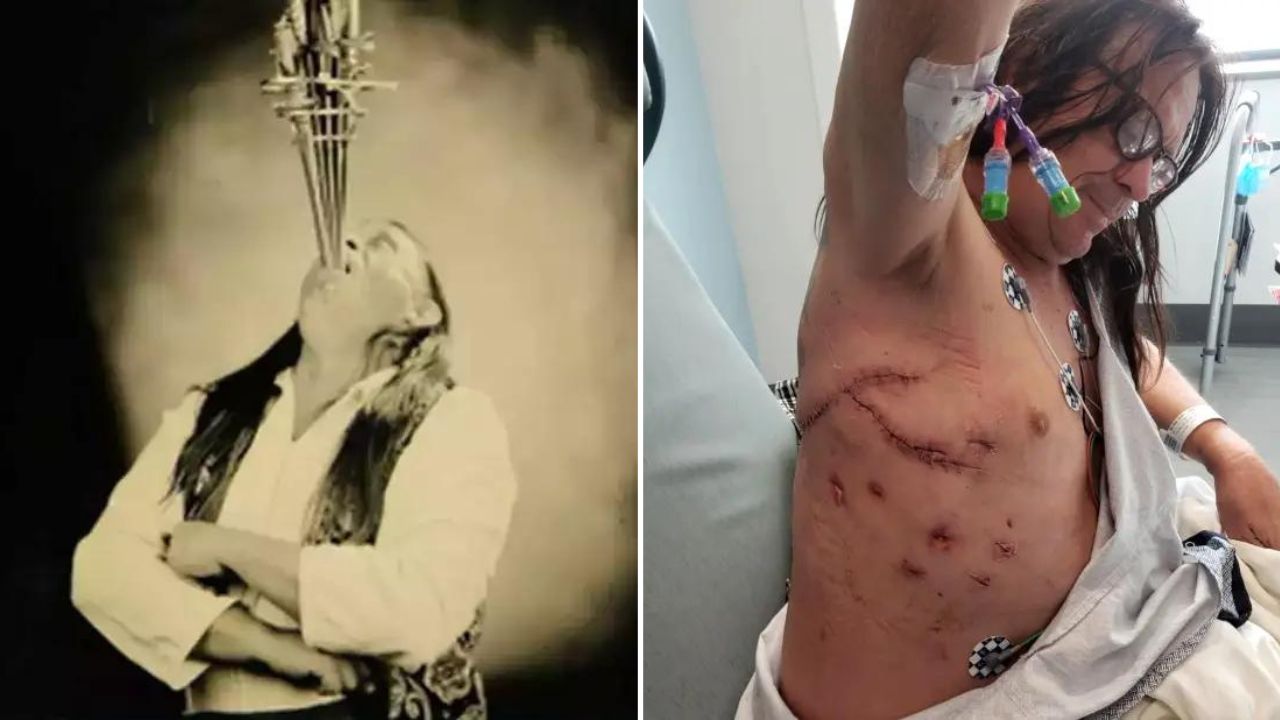 Engolidor de espada fica em coma por um mês após acidente quase fatal