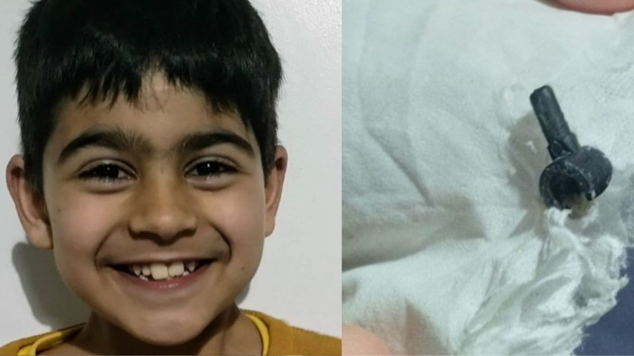 Garoto neozelandês viveu sete anos com uma peça de Lego em seu nariz