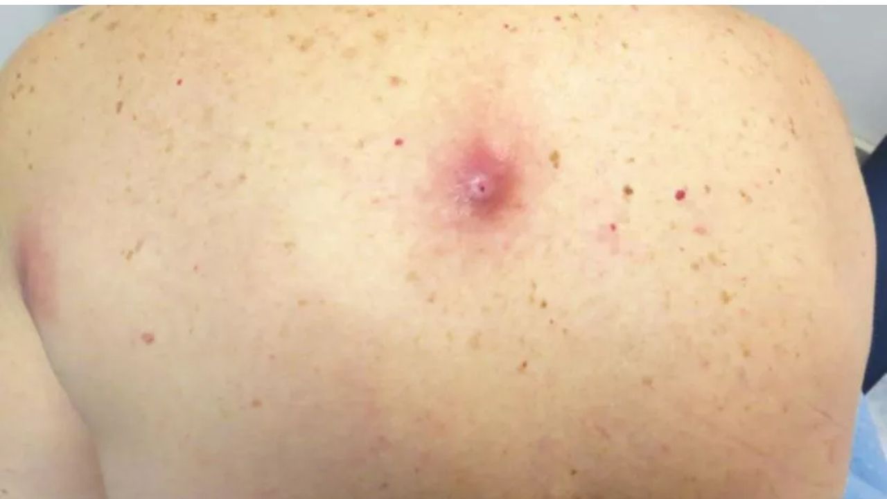 Estudo revela que mulher tinha larvas crescendo em costas e nádegas