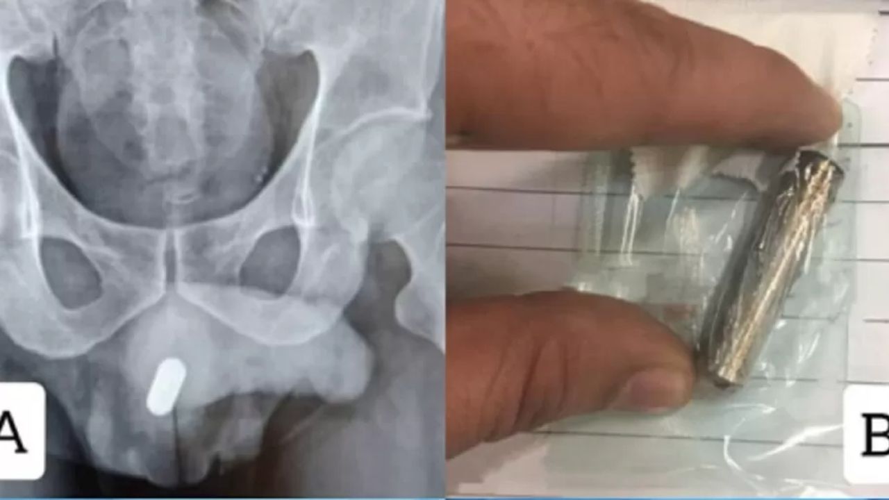 Iraniano passa por cirurgia para retirar pilha do pênis