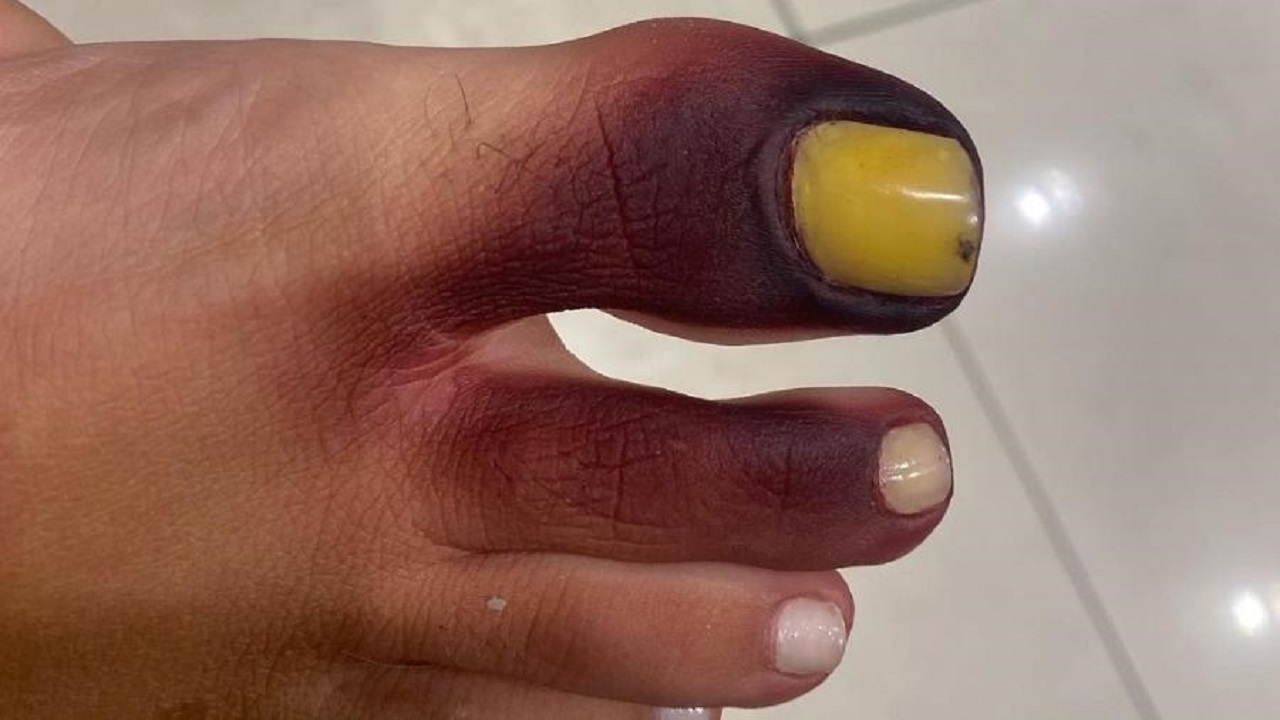 Dedo roxo e unha amarelada: Piolho-de-cobra deixa ferida ‘assustadora’ em pé de empresária