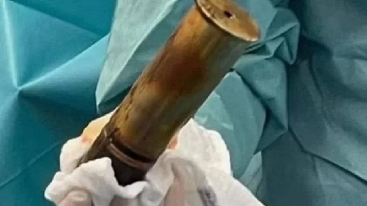 Hospital é evacuado após homem aparecer com bomba da 1ª Guerra alojada no reto