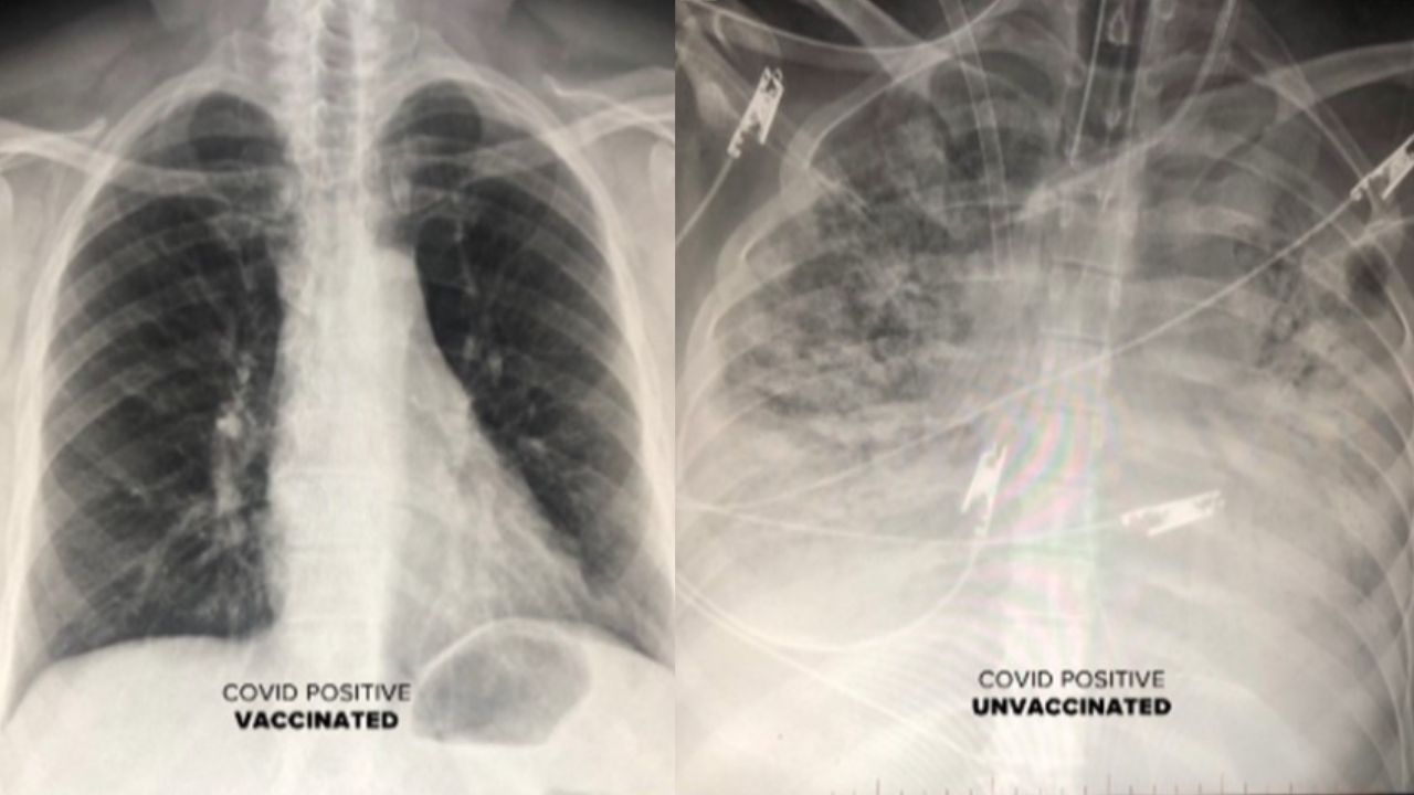 Médico mostra como a Covid age diferente nos pulmões dos vacinados e dos não imunizados