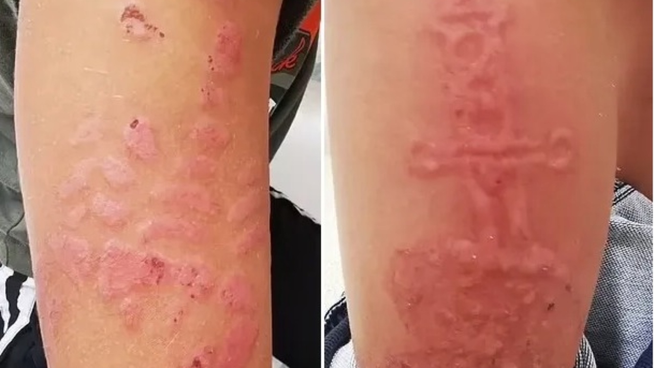 Após fazerem tatuagens com henna, irmãos sofrem queimaduras químicas