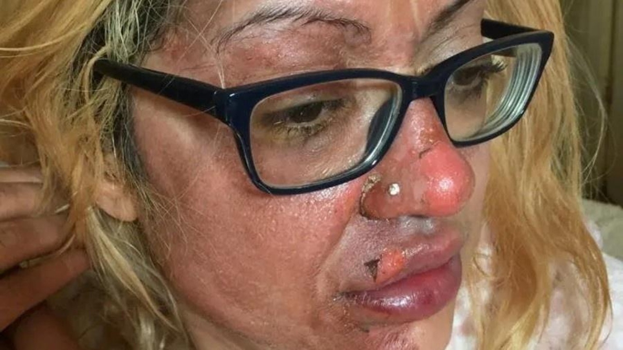 Mulher queima parte do rosto depois de explosão ao fazer ovo no micro-ondas