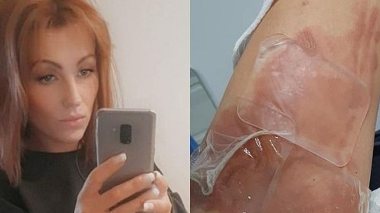 Em fast food, cliente sofre queimaduras nas pernas em decorrência de copo mal tampado