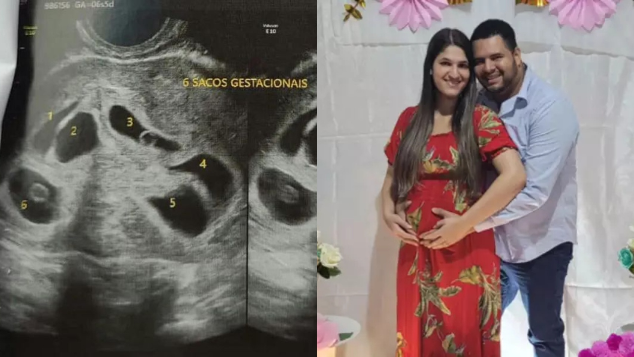 Em parto de apenas 10 minutos, mulher dá à luz sêxtuplos no Espírito Santo