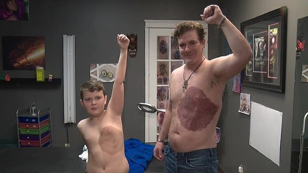 Canadense passa 30 horas tatuando marca de nascença igual à do filho