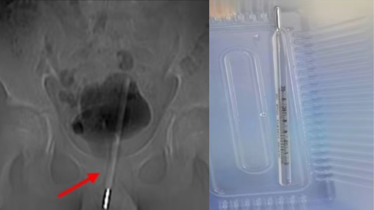 Após colocar termômetro dentro do pênis, garoto precisa de cirurgia