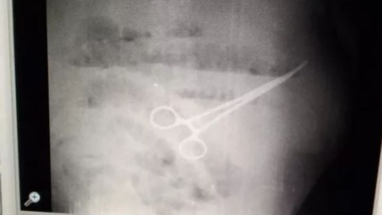 Homem morre após passar por cirurgia e ficar com tesoura no estômago na Venezuela