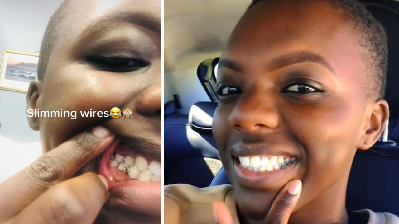 Técnica extrema: Mulher ‘tranca’ seus dentes com arame para emagrecer