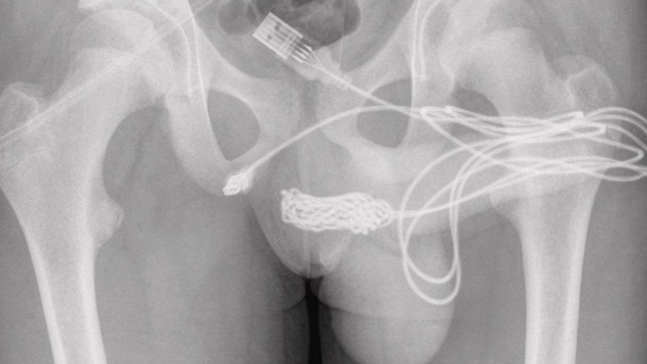 Virou artigo cientifico: Jovem tenta medir órgão genital com cabo USB e acaba parando no hospital