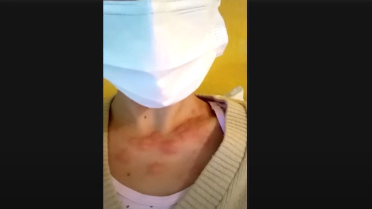 Com suspeita de varíola dos macacos, mulher desabafa sobre sintomas: ‘Muitas dores’