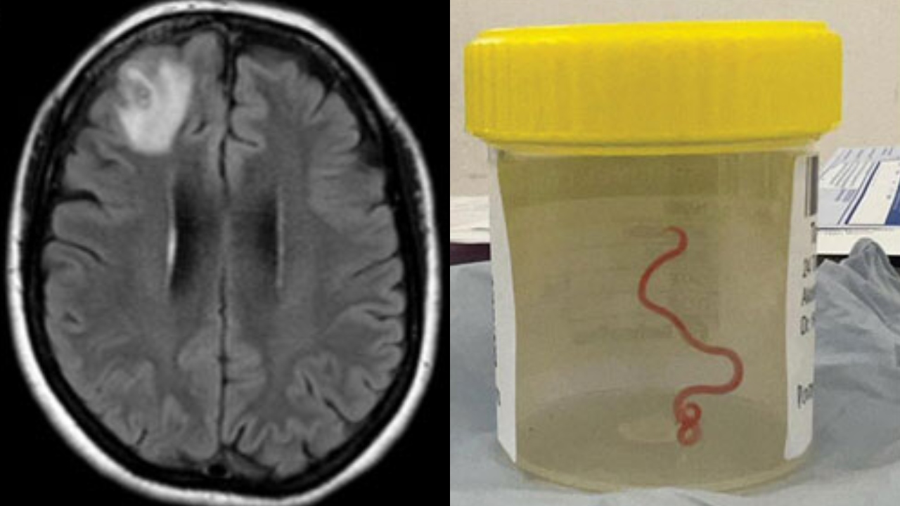 Mulher descobre verme de 8 cm no cérebro, após procurar atendimento para dores abdominais