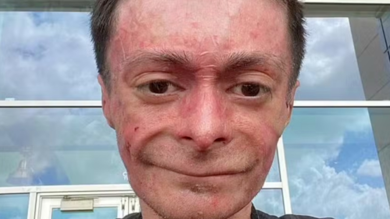 Entenda a doença rara que faz a pele de um homem desmanchar ao toque
