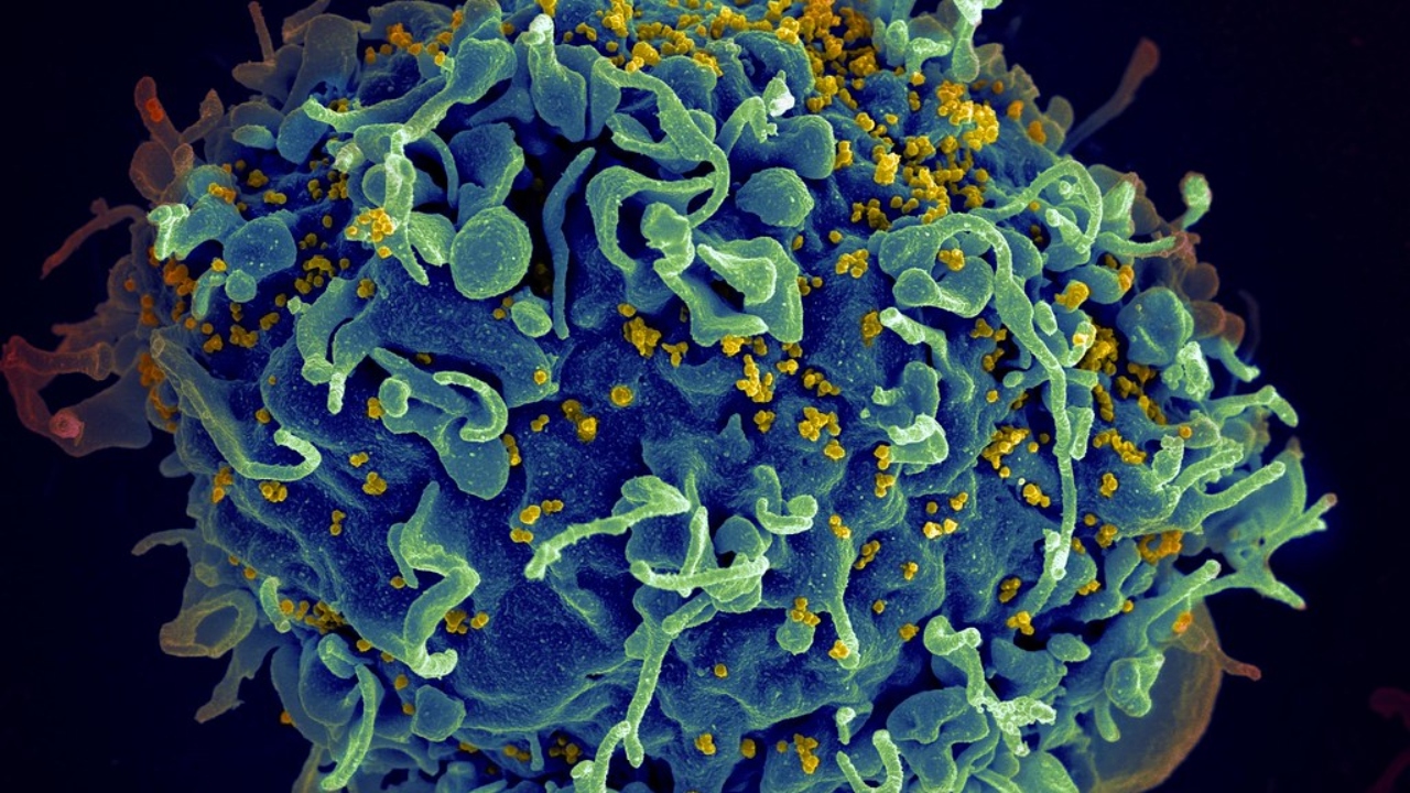 Paciente com HIV é terceiro a ser curado após transplante de células-tronco